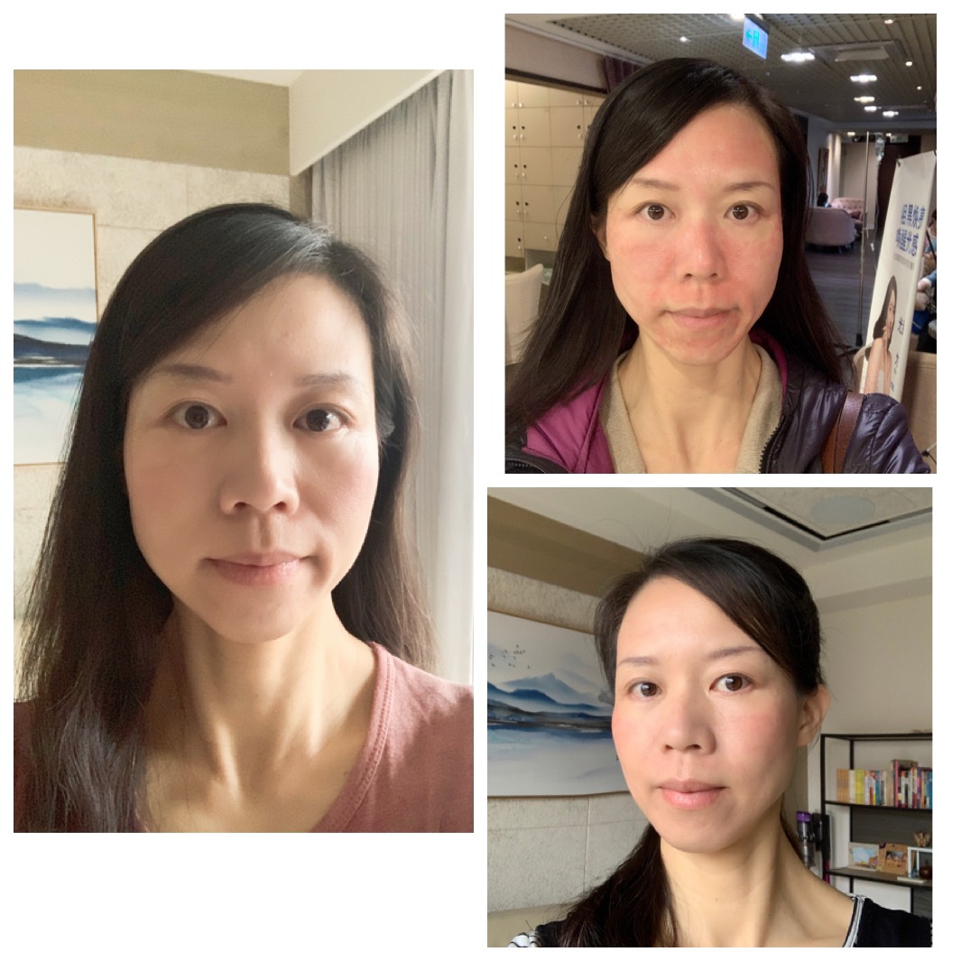 【皮秒雷射】星采整形外科診所(大安)- 打完皮秒最先感受到的是膚色白了一階 ，之後隨著恢復期會發現一些黑斑痘疤慢慢變淡！！～-Cinya的私房烘焙課